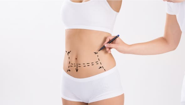 Tummy Tuck